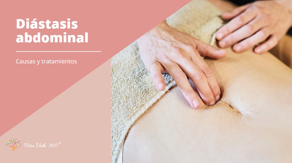 diástasis abdominal